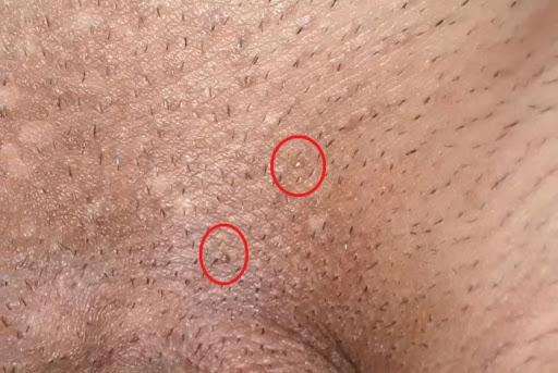 Genital Ziyillər (Genital Warts) - Dermatoloq Dr.Mehdi Mahmudi