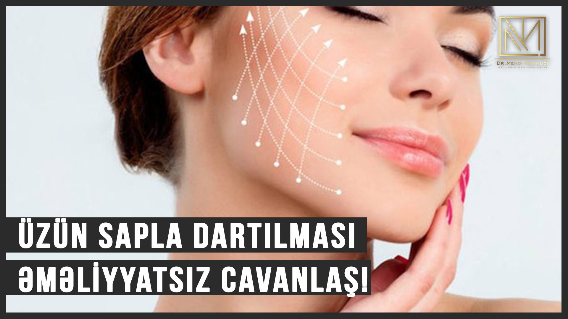 Üzün Sapla Dartılması - Əməliyyatsız Cavanlaş! Kosmetik Dermatoloq Dr.Mehdi Mahmudi