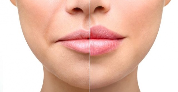 Anti Aging Program: Botoks, Nazolabial Dolğu və Liftinq Saplar