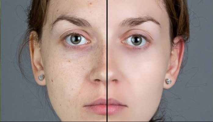 Lazer ilə günəş ləkələri və postakne izlərin müalicəsi - Dermatoloq