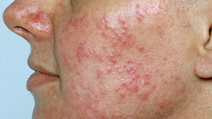 Rosacea (Qızılgül Xəstəliyi) Səbəbləri Nədir?