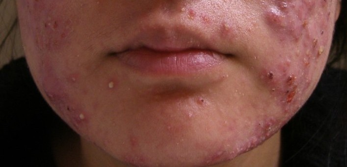Gənə Xəstəliyi - Demodeks | Dermatoloq Hekim
