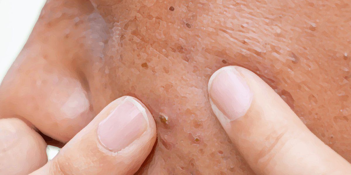 Stres Sızanağı Necə Artırır?