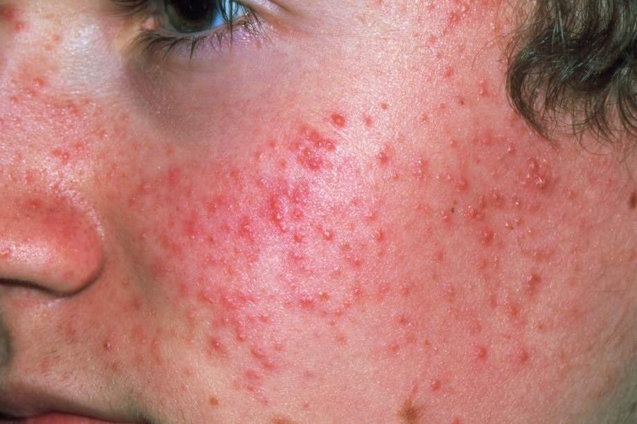 Gənə Xəstəliyinin Müalicəsi - Demodeks Nədir? | Dermatoloq Hekim