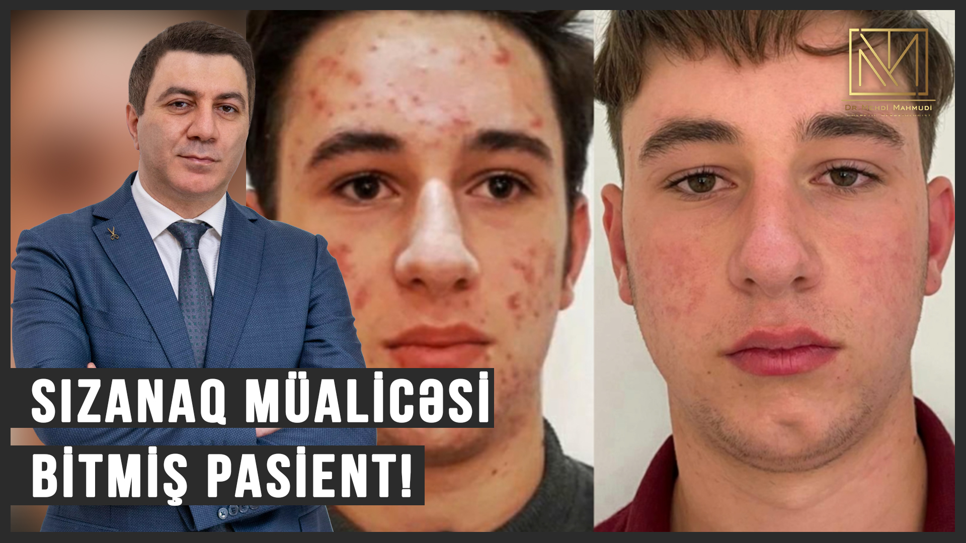 Sızanaq Müalicəsi (Akne Xesteliyi) - Dermatoloq Hekim