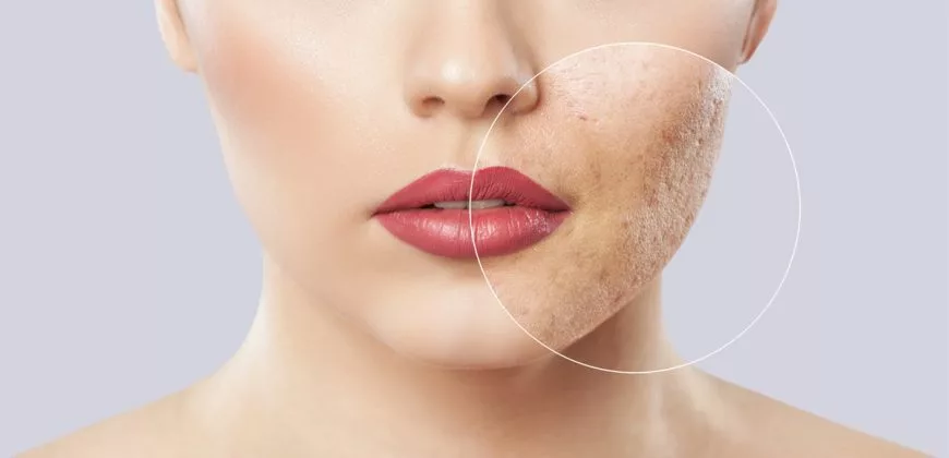 Dermatoloq | Akne Müalicəsi | Uzde Sepki | Sızanaq Müalicəsi | Dermatoloq Mehdi Mahmudi