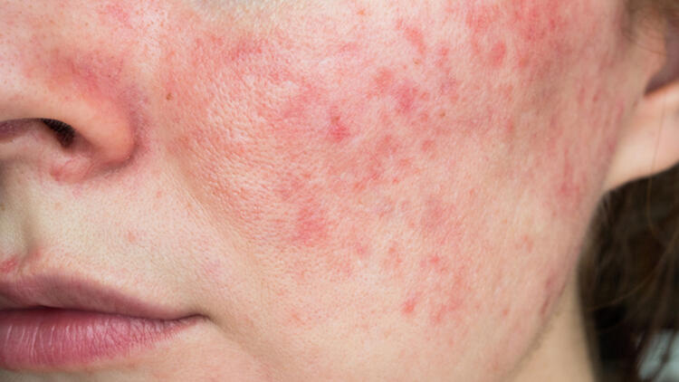 Akne Rozasea Müalicəsi / Dermatoloq Mehdi / YouTube Video 