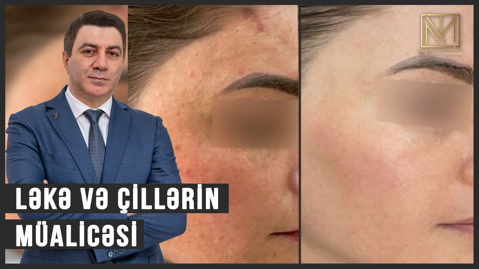Ləkə və Çillərin Müalicəsi | Dermatoloq Hekim | www.drmehdimahmudi.az