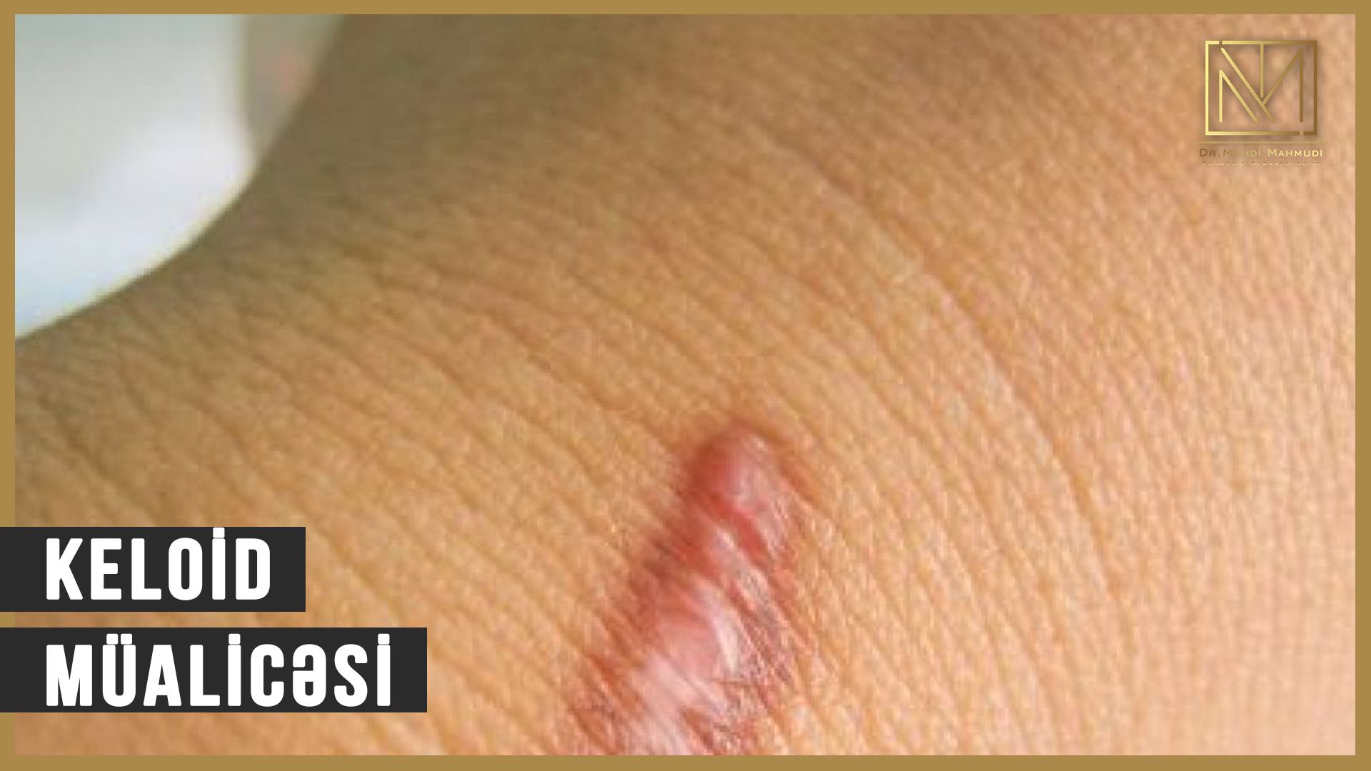 Keloidlərin Müalicəsi | Dermatoloq Mehdi Mahmudi