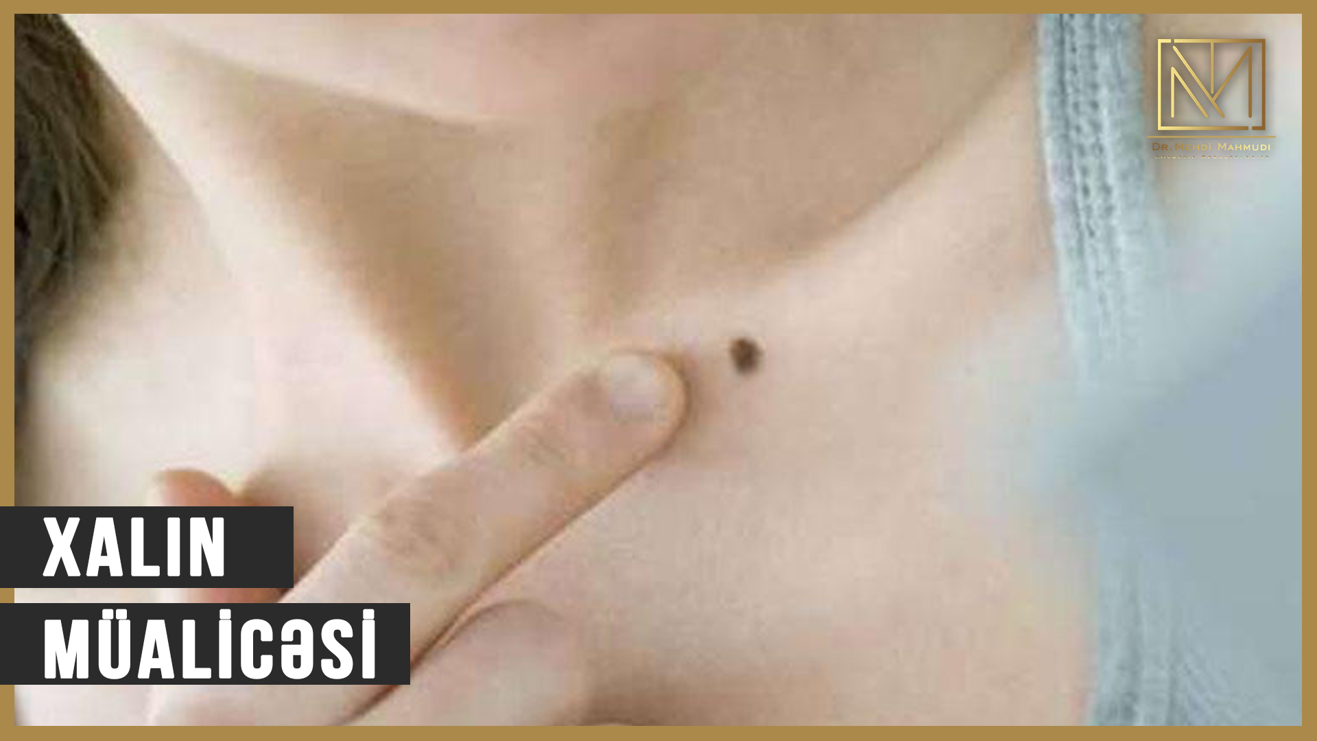 Xalın cərrahi müalicəsi #xalmualicesi #dermatoloq