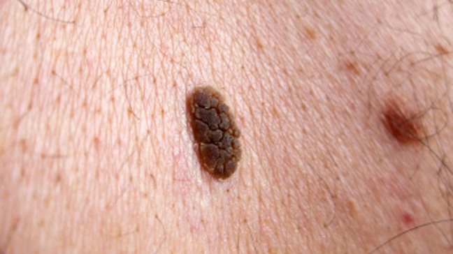 Seborrheic keratosis Müalicəsi / Dermatoloq Dr Mehdi