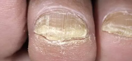 Dırnaq xəstəlikləri müalicə olunurmu? Dermatoloq Həkim Mehdi Mahmudi