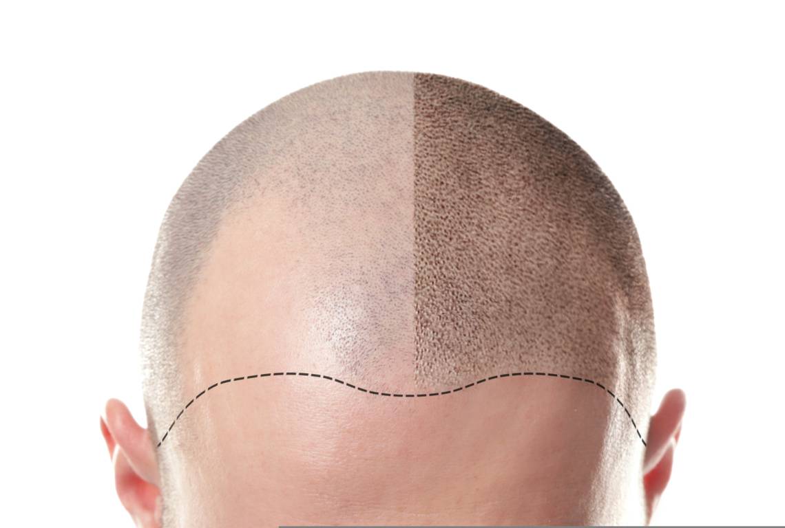 Kişi tipli saç tökülməsi nədir? Androgenetik alopesiya Müalicəsi necədir?