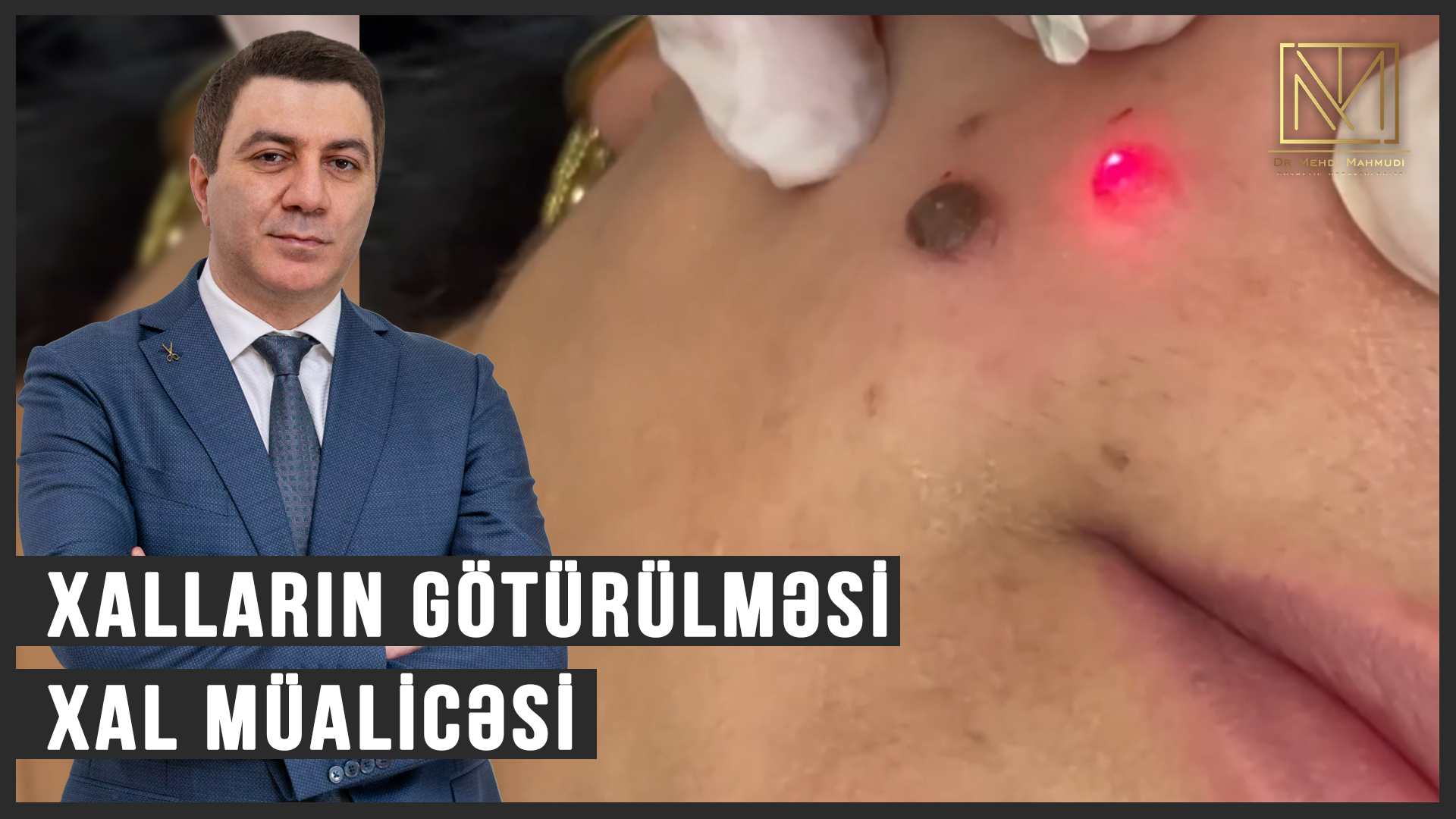 Xalların Götürülməsi / Xal Müalicəsi / Lazer / Dermatoloq Hekim