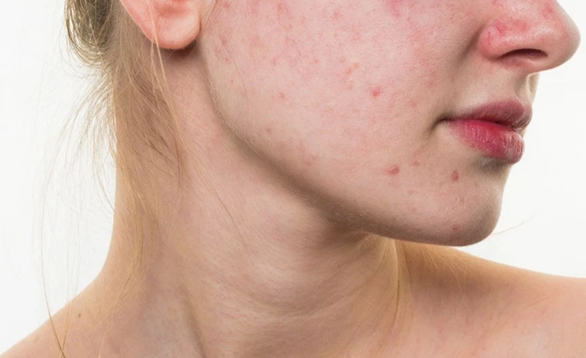 Akne vulgarisə səbəb olan nədir? Dermatoloq Mehdi Mahmudi