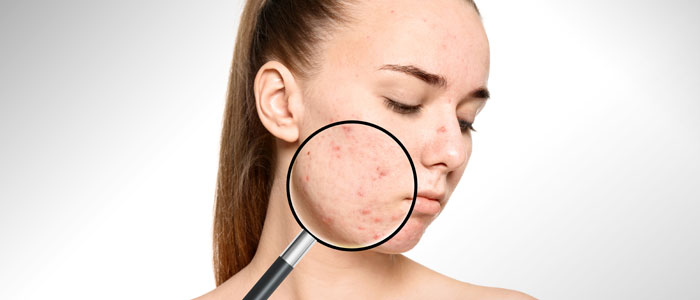 Sızanaq Hansı Yaşlarda Yaranır / Sızanaq Haqqında / Dermatoloq Mehdi