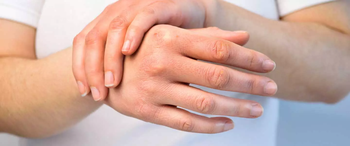 Quru Dəri (KSEROSİZ) - Quru dəri: simptomlar və səbəblər #dermatoloq #mehdi