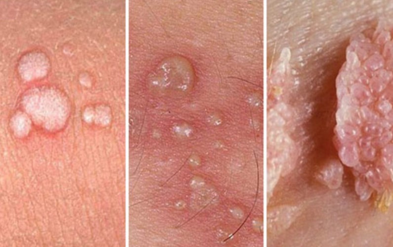 Papilloma nədir? – Səbəbləri, əlamətləri və müalicəsi