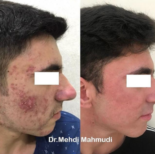 Mehdi Mahmudi Neticeler